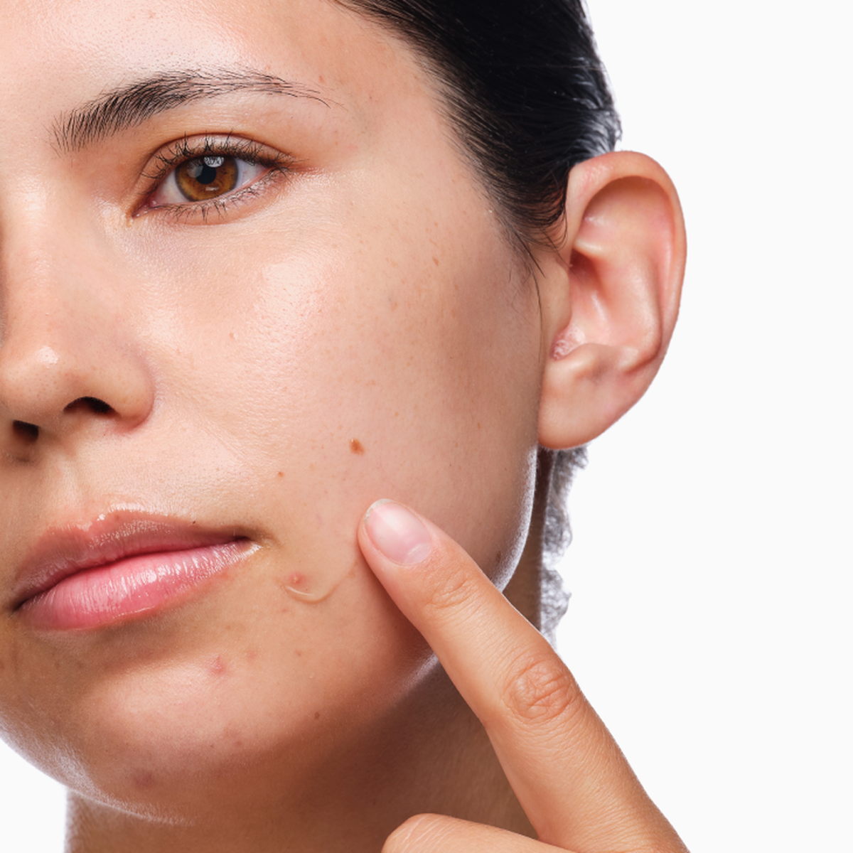 the-acne-set-f8 rdn-the-acne-set-application.png
