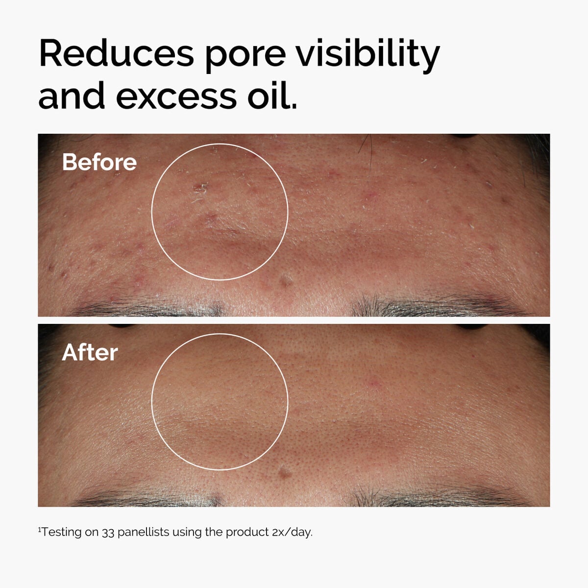 niacinamide-10-zinc-1-x7 ord-niacinamide-zinc-blemish-serum-before-after-pores.jpg