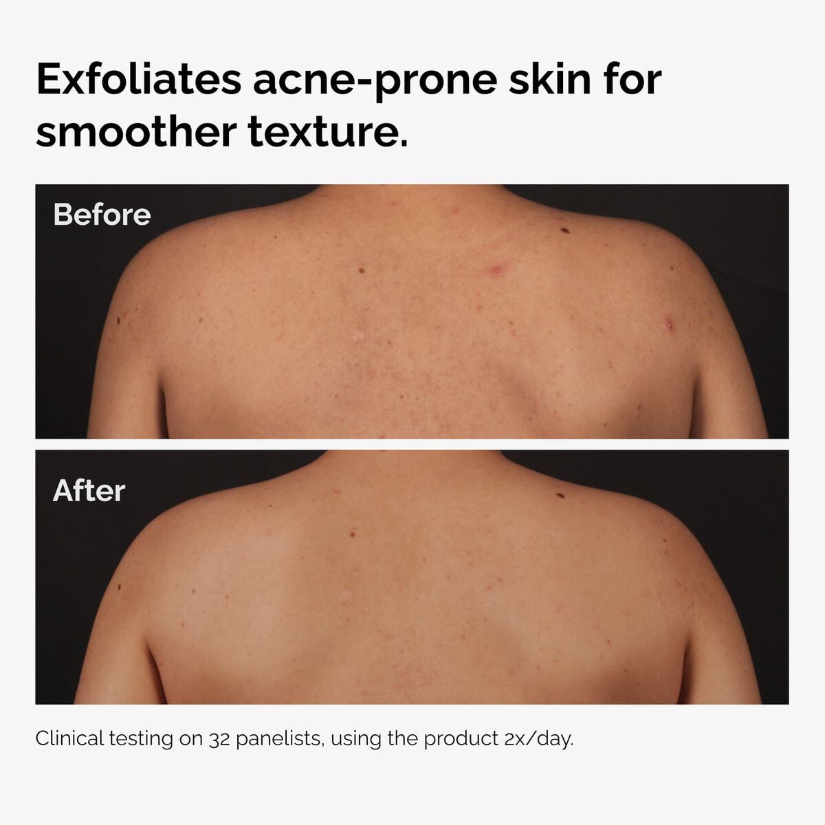 salicylic-acid-0-5-body-serum-k5 ord-salicylic-acid-body-serum-before-after-graphic-NA.jpg
