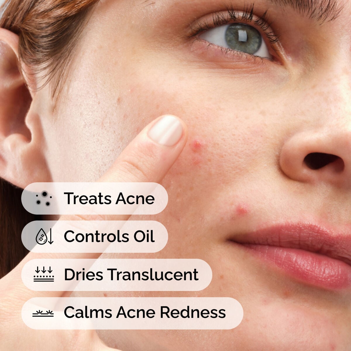 sulfur-10-powder-to-cream-concentrate-p9 ord-sulfur-10pct-powder-to-cream-concentrate-model-application-with-benefits-acne.jpg